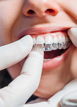 Dentist placing clear aligner on patient